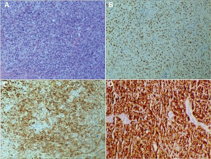 【佳学基因检测】基因检测鳞细胞肺癌EGFR突变伴PD-L1表达后的制定出帕博利珠单抗靶向药物治疗 【佳学基因检测】基因检测鳞细胞肺癌EGFR突变伴PD-L1表达后的制定出帕博利珠单抗靶向药物治疗